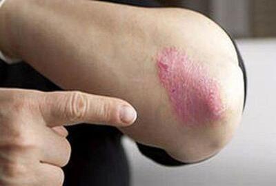  از بیماری «پسوریازیس» چه می‌دانید