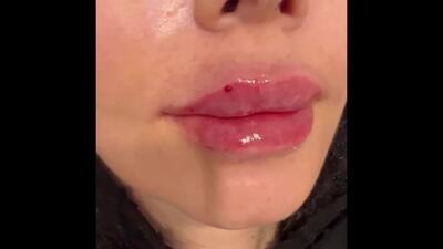  نمونه کار تزریق فیلر لب