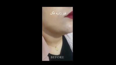  فیلر زاویه فک