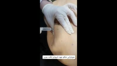  مزوتراپی شکم جهت لیپولیز بافت چربی