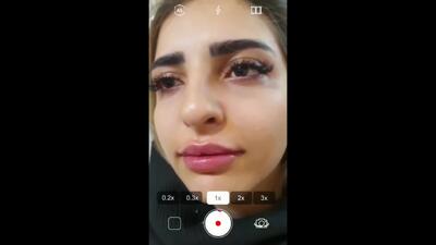  فیلر لب