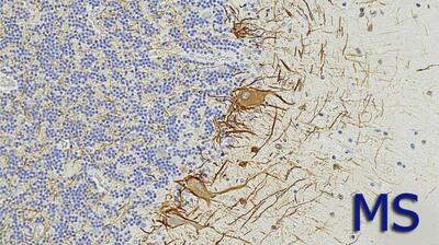  میگنا - نشانه‌های خونی ممکن است ابتلای به ام‌اس را تا هفت سال پیش از بروز علائم پیش‌بینی کنند