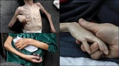  چه تعداد در غزه به دلیل سوء تغذیه به شهادت رسیدند؟