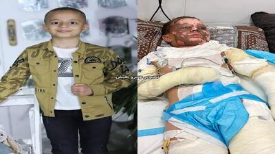  ۳۵ درصد سوختگی پسر ۱۱ فلسطینی بخاطر شی اسرائیلی