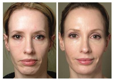  خطرات ماندگاری ژل پاژ در شقیقه و بهترین روش برای تخلیه ایمن آن