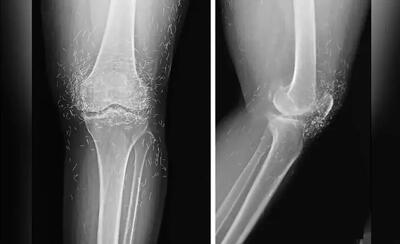  کشف صدها رشته طلای خالص در زانوی زن مبتلا به آرتروز