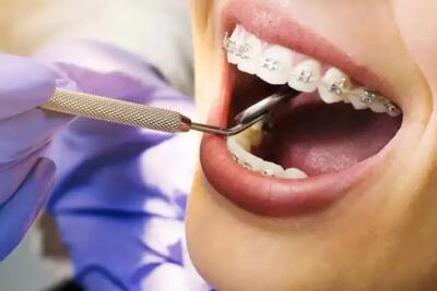  ۱۲ غذای مناسب پس از جراحی دندان عقل