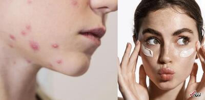  آیا استفاده از ضدآفتاب روی جای زخم آبله‌مرغان بی‌خطر است؟