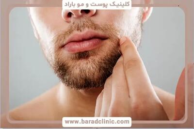 کاشت ریش ؛ راه‌حلی دائمی برای ریش‌های کم‌پشت و ناهماهنگ، جذاب‌تر از همیشه!