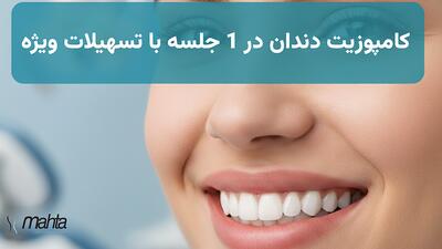  کامپوزیت دندان در 1 جلسه + وام ۳۰۰ میلیونی (خبر خوب برای تهرانی‌ها)