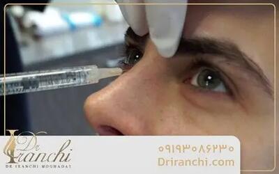  چرا تزریق فیلر بینی در تهران محبوب شده است؟