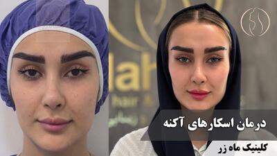  درمان اسکارهای آکنه ( کلینیک پوست، مو و زیبایی ماه زر )