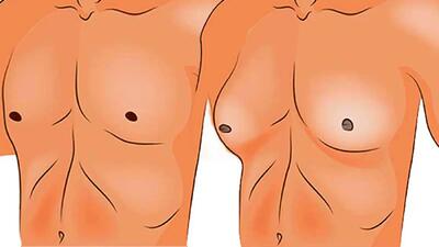  ژنیکوماستی چیست؟ / جدول مواد غذایی مفید و مضر برای ژنیکوماستی