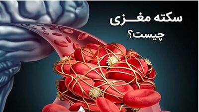  سکته مغزی دومین علت مرگ ایرانی‌ها