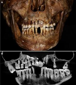  دندان ۱۶۰۰ ساله، کلید رمزگشایی از زندگی زاهدانه یک زن باستانی شد