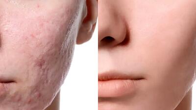  مزوتراپی صورت چیست؟