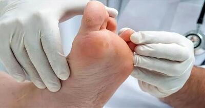  از چالش ها تا راهکارهای درمانی زخم پای دیابتی