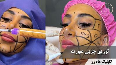  تزریق در لایه‌های پوست! ( کلینیک زیبایی ماه زر )