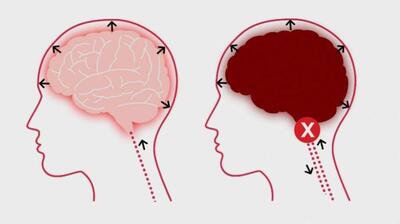  میگنا - مردم هنوز مرگ مغزی را نمی‌شناسند