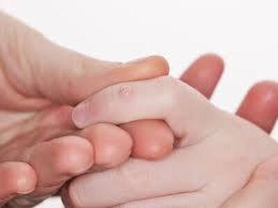  از علت تا درمان زگیل‌های دوران کودکی