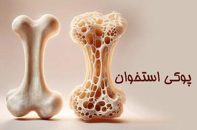  ارتباط بین مصرف زیاد نمک و پوکی استخوان