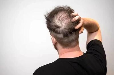  چهار توصیه مهم برای کسانی که ریزش مو دارند