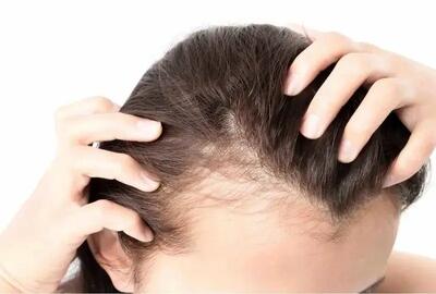  چهار توصیه مهم برای کسانی که ریزش مو دارند