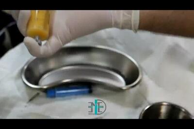  تزریق چربی با دستگاه پزشکی Nano Fat Kit