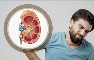 درد سنگ کلیه شما را کلافه کرده است این نوشیدنی ها مختص شماست