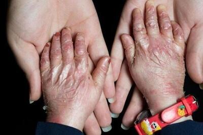  ۹۵ درصد بیماران «ای بی» حاصل ازدواج فامیلی/ امکان تشخیص پیش از تولد وجود ندارد