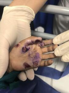  ماجرای مرگ کودک ۴ساله/ خانواده ادعا کرده‌اند؛ کودک از بالای درخت افتاده، اما کادر درمان از کودک آزاری خبر می دهند