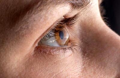  چرا چشم ایرانی‌ها بیشتر درگیر قوز قرنیه است؟