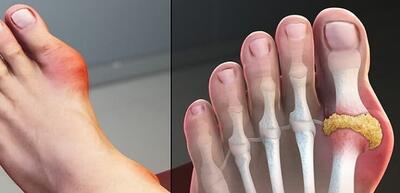  نشانه های نقرص این بیماری مفصلی چیست؟