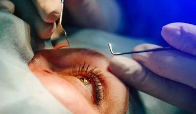  شیوع قوز قرنیه در ایران بالاتر از جهان | این عوامل باعث نابینایی شما می‌شوند - کلبه سرگرمی