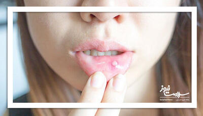 زخم‌های کوچک دهان؛ هشدار جدی سرطان