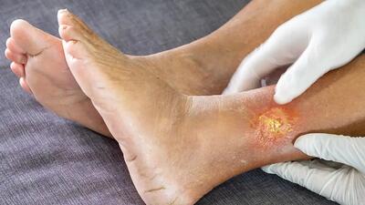  برای پیشگیری از زخم پای دیابتی چه کنیم