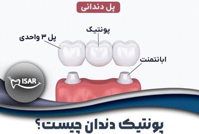  لبخندی دوباره با پونتیک دندان؛ بازگرداندن زیبایی و عملکرد طبیعی دهان