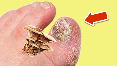  یک روش ساده و آسان خانگی برای درمان قارچ ناخن