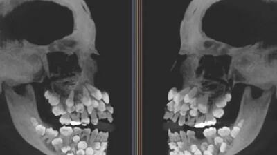  کشف نادر پزشکی در برزیل: دختری ۱۱ ساله که ۸۱ دندان دارد - گیمفا