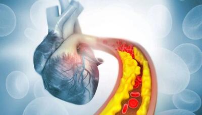  کاهش چربی خون با کمک ویرایش ژن برای اولین بار