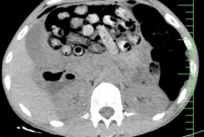  نجات جان مرد کرجی با خروج بیش از ۹۰ بسته مواد مخدر از معده و روده‌اش