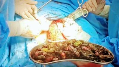  خارج کردن ۹۰ بسته مواد مخدر از معده یک فرد