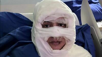  زنی در استانبول به اتهام سوزاندن چهره یک زن جوان روانه زندان شد