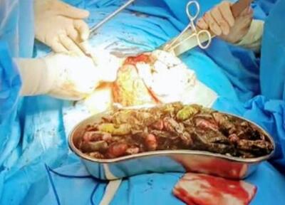  خروج ۹۰ بسته مواد مخدر از معده و روده یک مرد میانسال