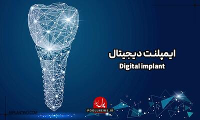  آشنایی با ایمپلنت دیجیتال برای کاشت دندان