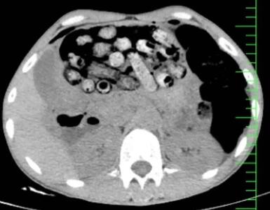  خروج ۹۰ بسته مواد مخدر از معده و روده بیمار در کرج