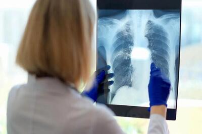  یک علت خستگی مزمن کشف شد