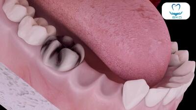  روکش دندان و ایمپلنت ترکیبی | سلامت کاشت درین