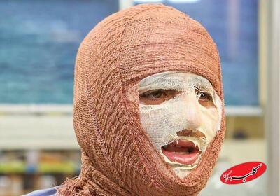  سوختگی؛ آسیب جسمی و روانی که فراتر از درمان است - کلبه سرگرمی