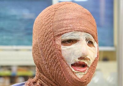 سوختگی؛ آسیب جسمی و روانی که فراتر از درمان است